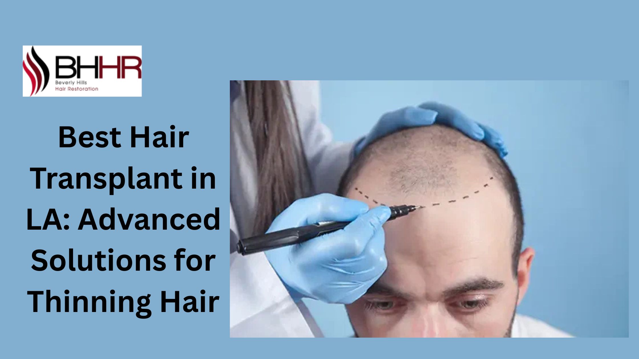 Best Hair Transplant in LA: Advanced Solutions for Thinning Hair