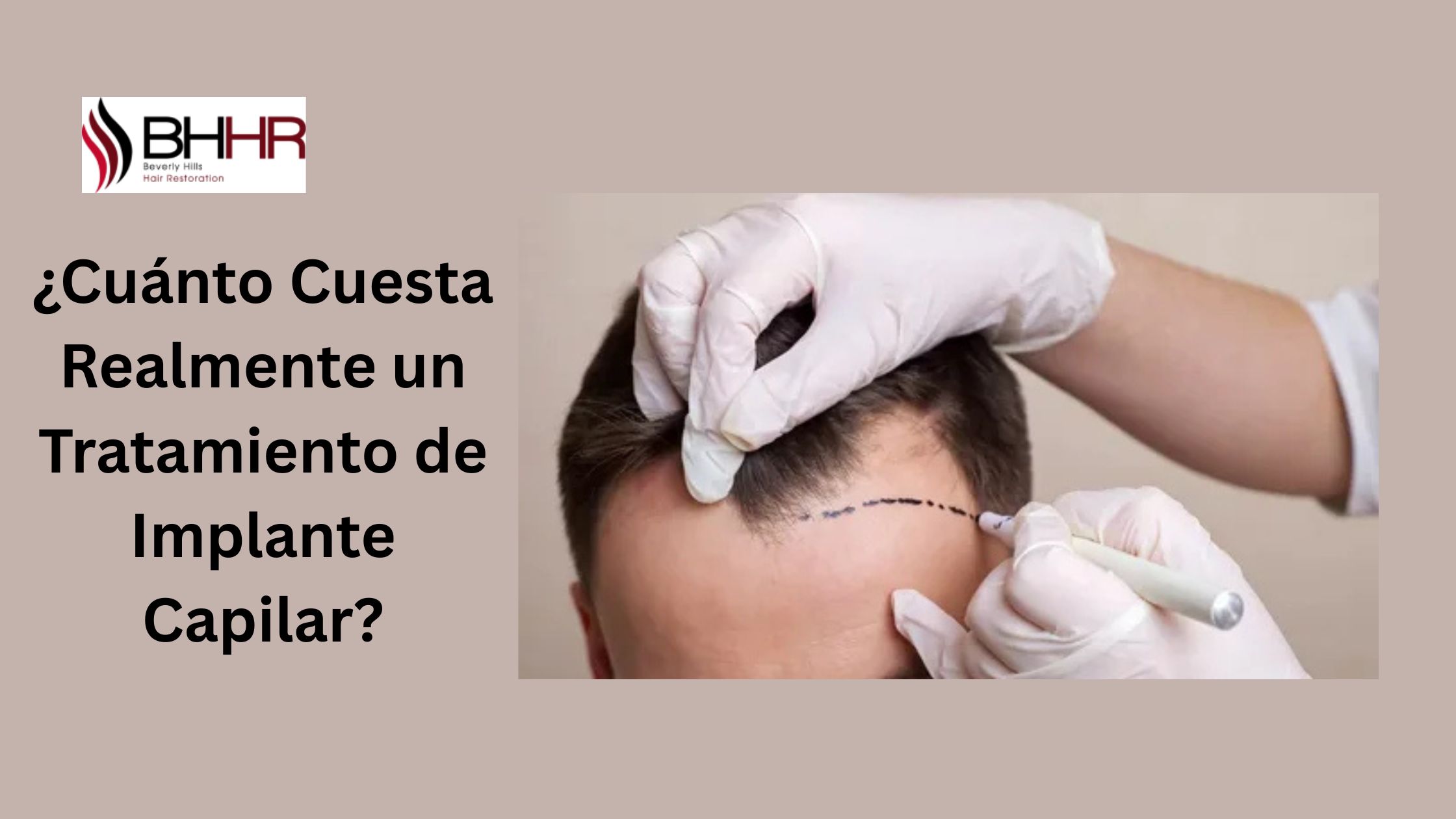¿Cuánto Cuesta Realmente un Tratamiento de Implante Capilar?