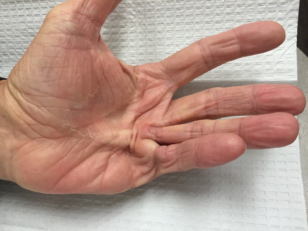 What Is Viking’s Disease? Causes, Symptoms & Treatment
