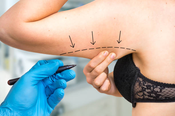 Arm Lift Surgery: Does It Tighten Underarm Skin Too