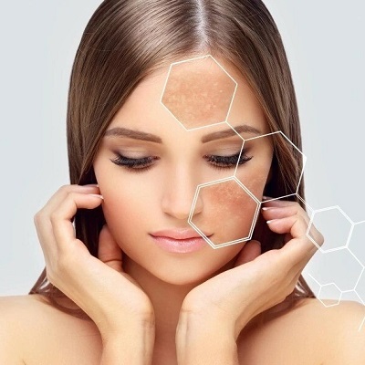 Can Melasma Treatment Restore Even Skin?