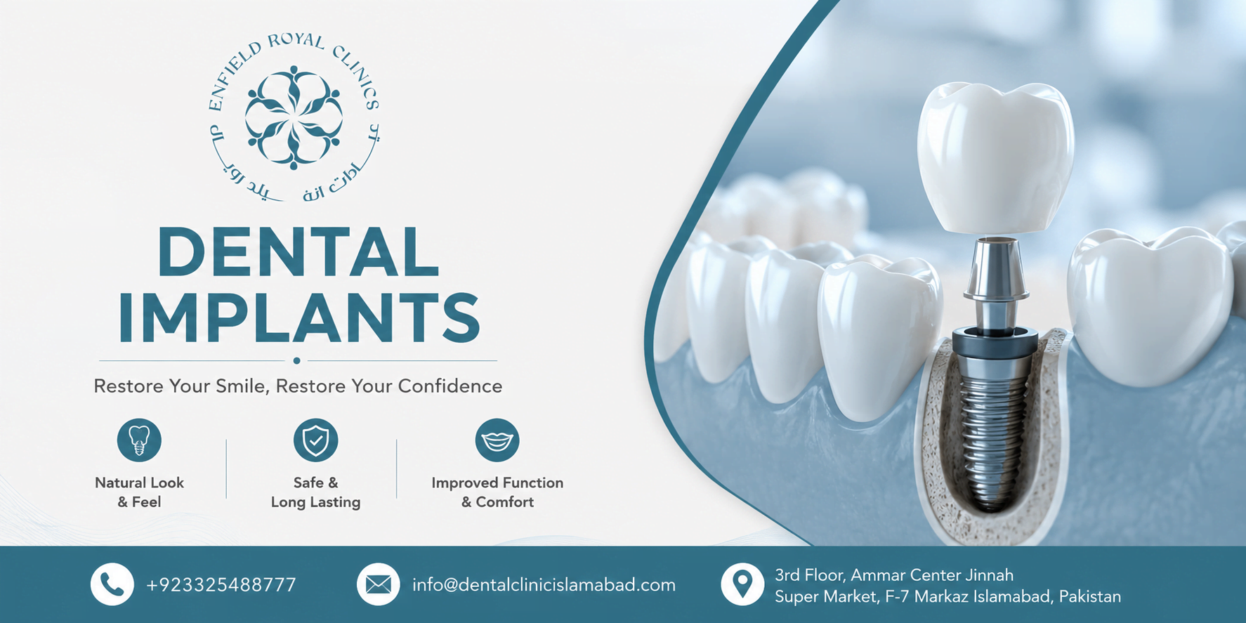 Best Dental Implants in Islamabad for Long-Lasting Results
