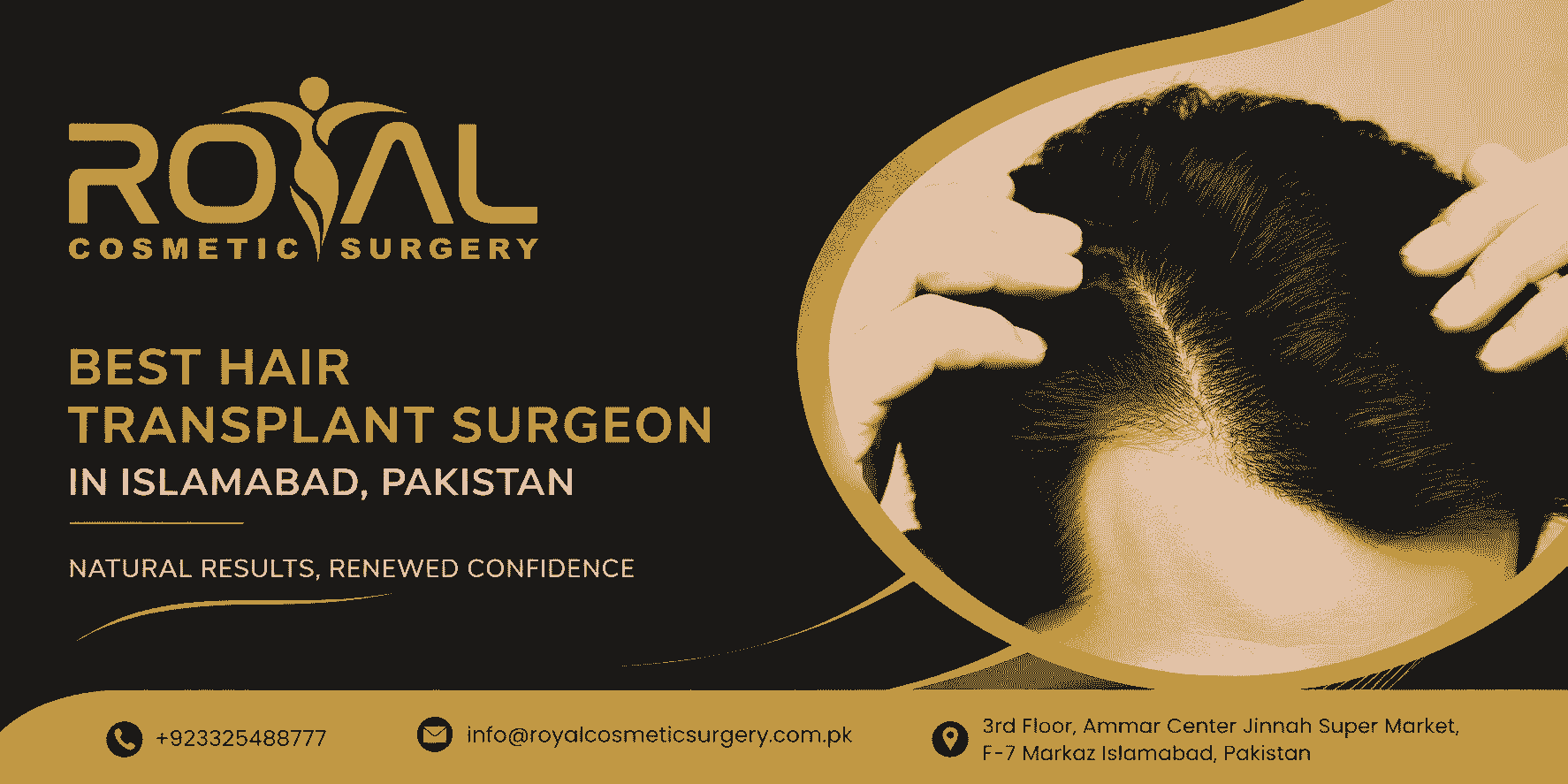 Best Hair Transplant Surgeon for Safe and Effective Treatment