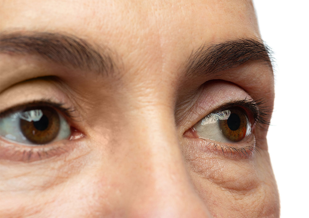 Top Clinics Offering Under Eye Fillers in Dubai