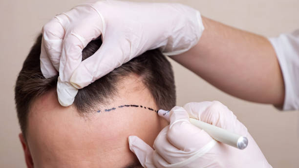 Hair Transplant Microscopic Graft Handling Importance