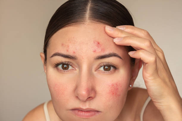Combining Topical Therapy with Laser Acne Scar Treatments