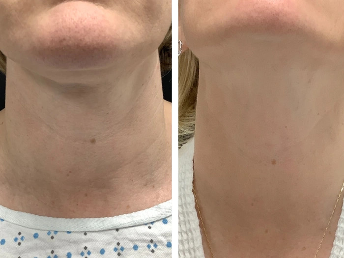 Radiofrequency (RF) Microneedling treatments in Dubai for Premium Aesthetic Care