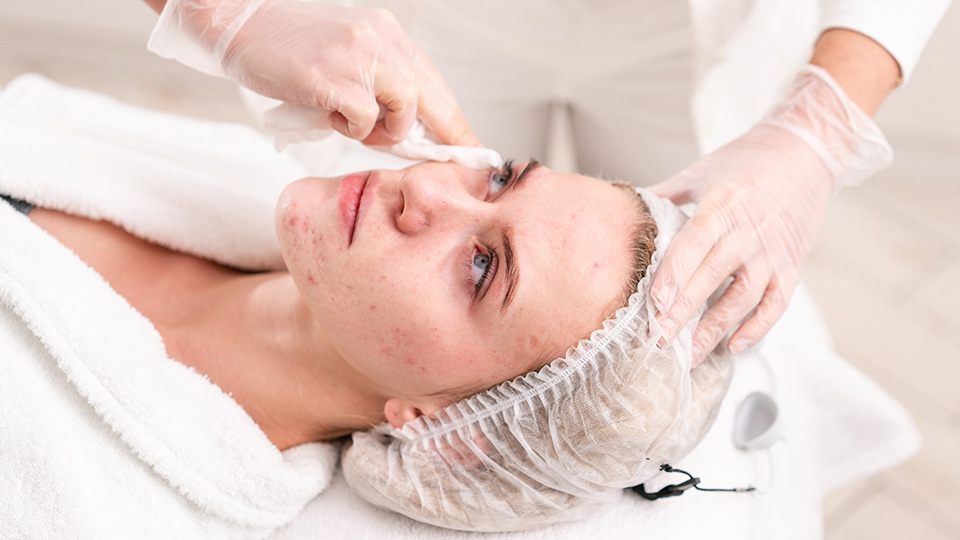 Why Adults Need Pimples Treatment in Dubai?