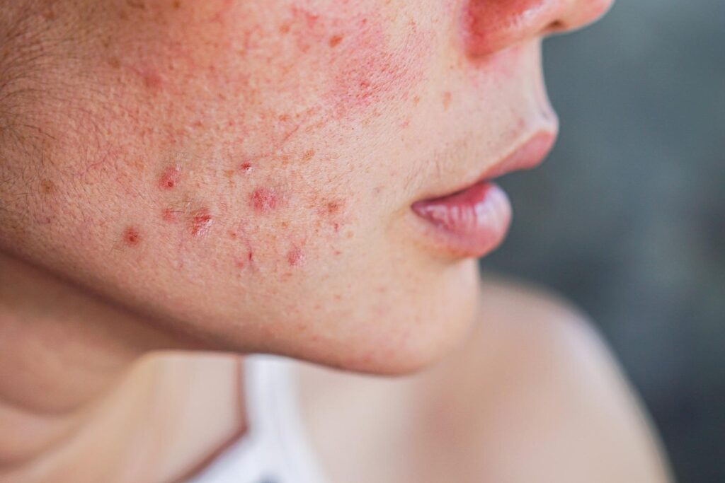 How Acne Treatment In Dubai Addresses Persistent Breakouts