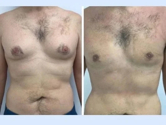 Best Doctors in Dubai for Gynecomastia: The Psychological Impact of Male Chest Contouring