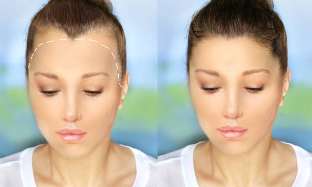 Who Is an Ideal Candidate for Hair Transplant in Riyadh Today?