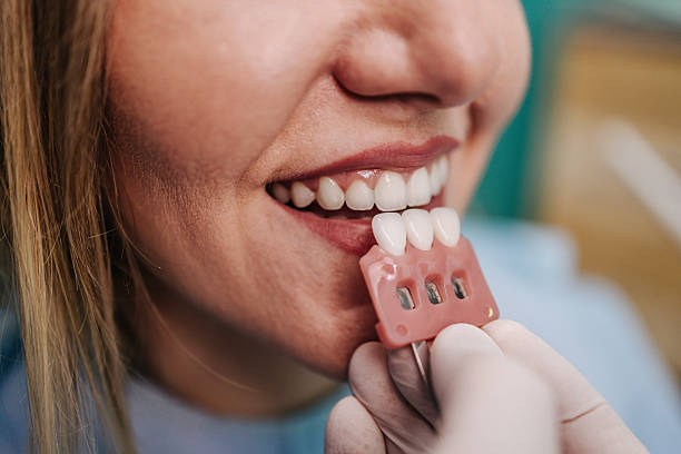 Is Teeth Whitening in Riyadh Worth It for Stubborn Discoloration?