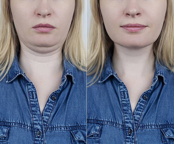 What Happens During Double Chin Removal in Abu Dhabi Treatment?