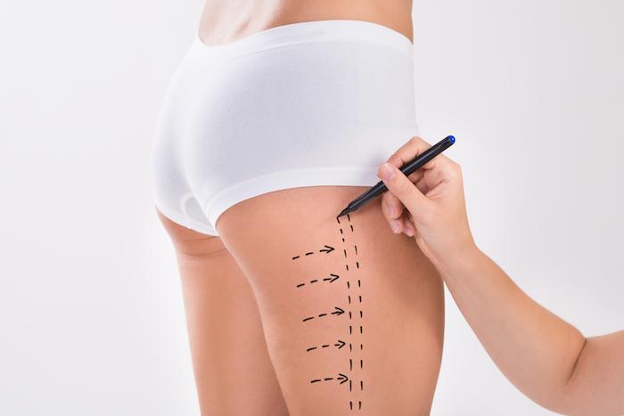Achieve Beautiful Curves with the Best Doctors in Dubai for Liposuction