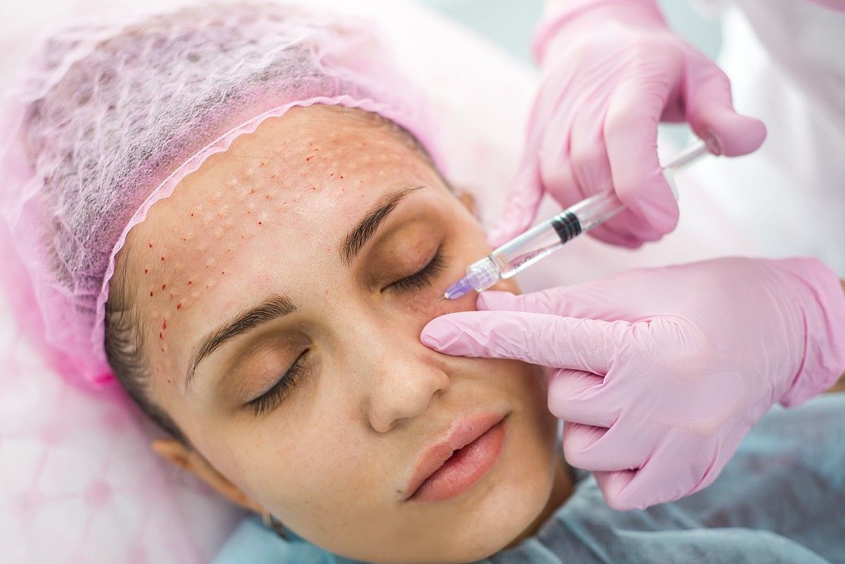 Mesotherapy in Islamabad: Improve Skin Health with Advanced Rejuvenation Therapy
