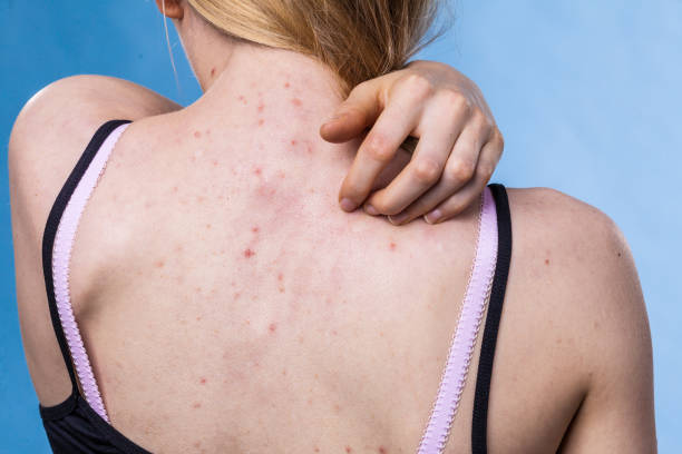 How to Treat Back Acne through Smart Product Layering Techniques