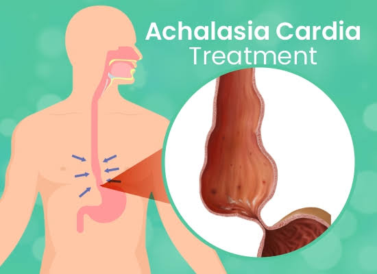 Achalasia Cardia: Natural Remedies to Combat Symptoms