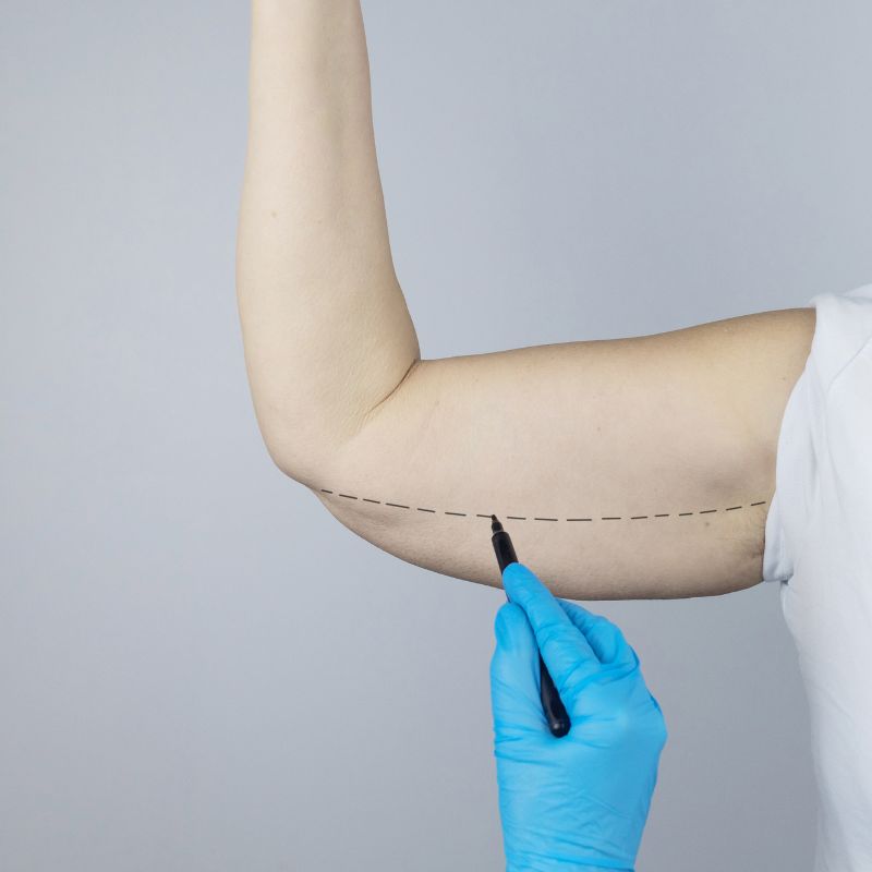 Arm Lift Surgery in Dubai: What Makes a Clinic Stand Out?