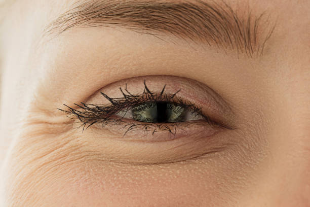 How Stress and Fatigue Can Make Eye Bags Look More Noticeable