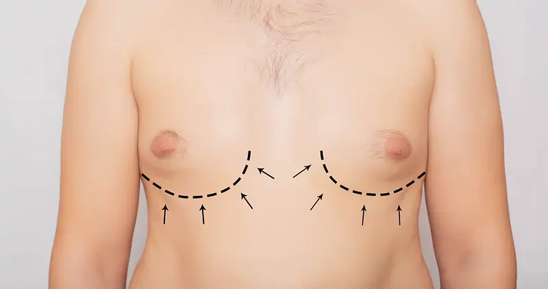 When Is Follow-Up Needed After Gyno Surgery?