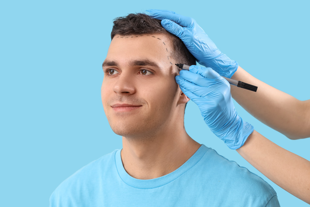 Hair Transplant in Islamabad: Common Questions Pakistani Patients Ask Before Treatment