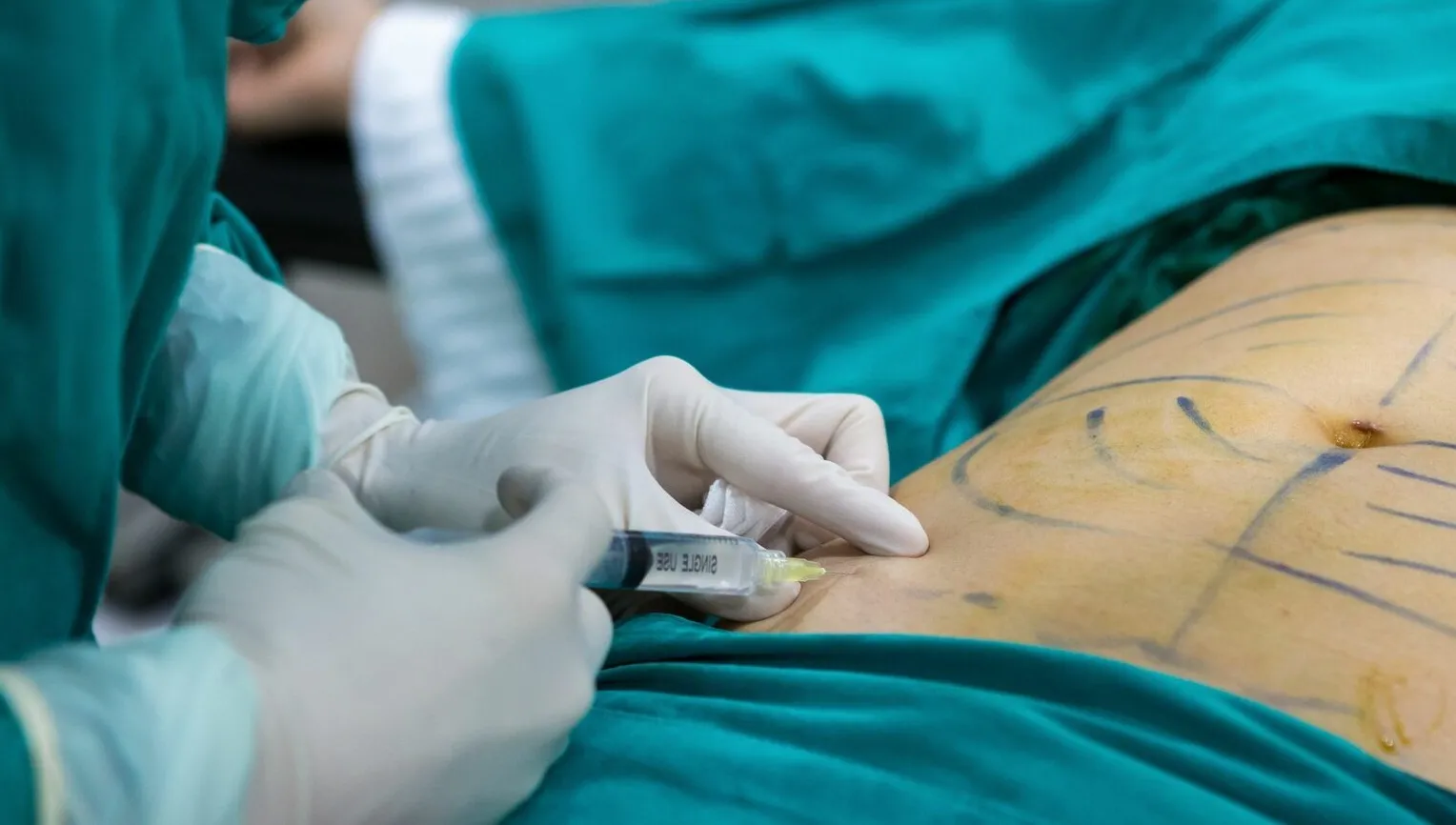 Does Liposuction Provide Permanent Results