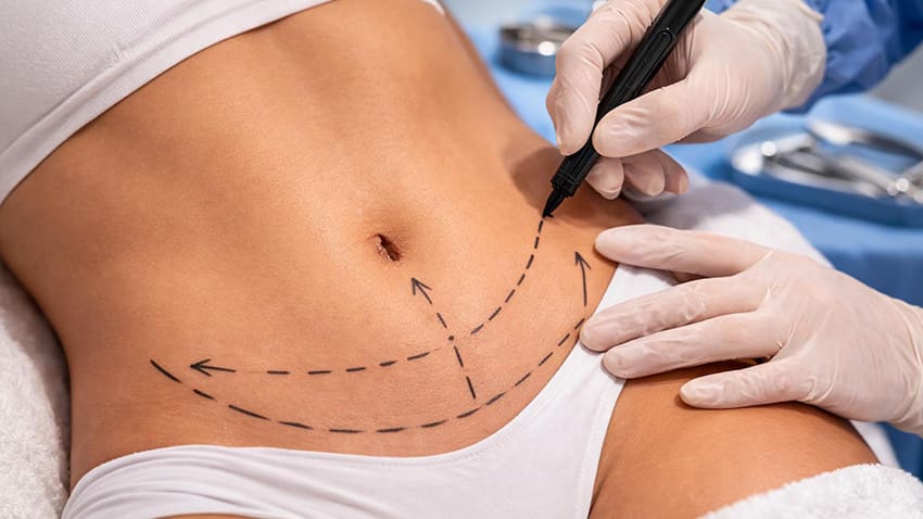 Liposuction in Islamabad: Everything You Need to Know About Fat Reduction