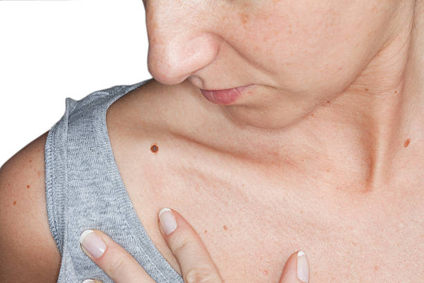 Preparing for Mole Removal: Medical and Skincare Advice