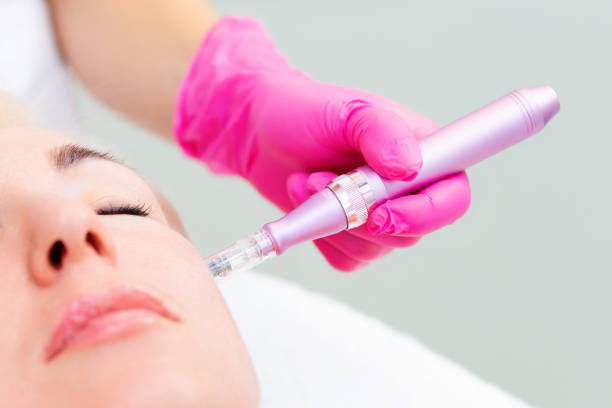 Potenza Microneedling Explained: Benefits, Process, and Recovery