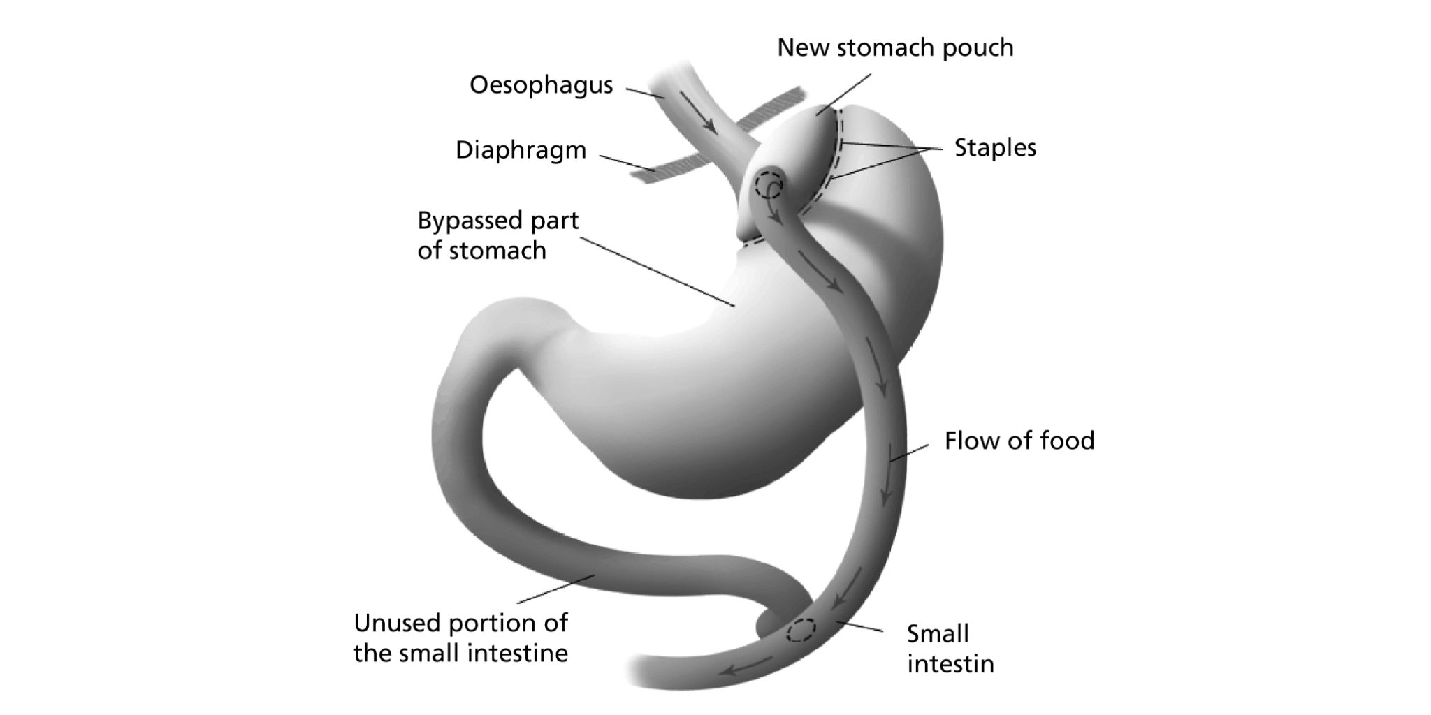 Can Teenagers Have Gastric Bypass Surgery What to Know
