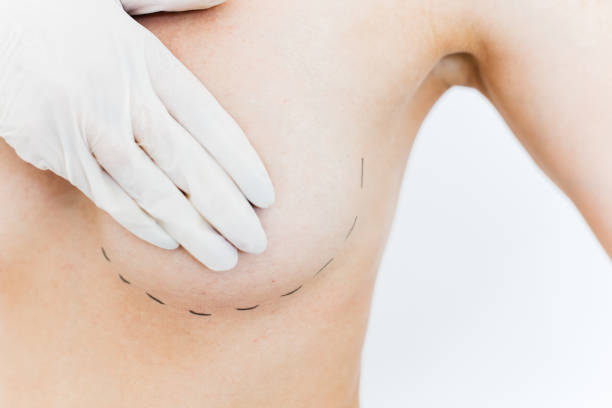What Results Can You Expect From Silicone Breast Implants