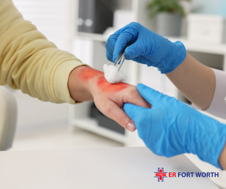 minor burn treatment