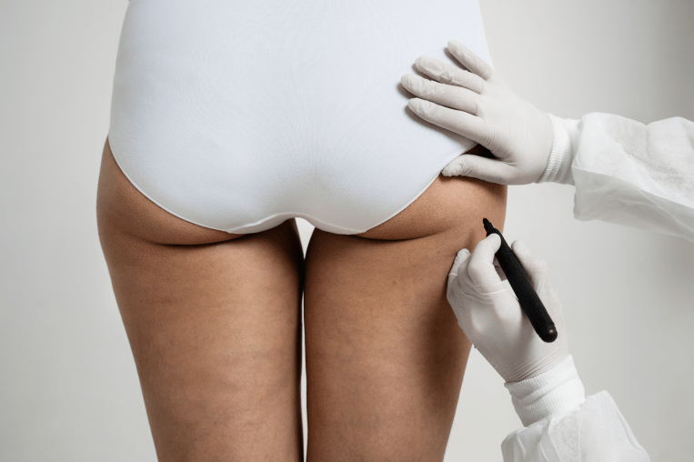 Why Does Choosing the Right Clinic Matter for Buttock Augmentation Surgery?