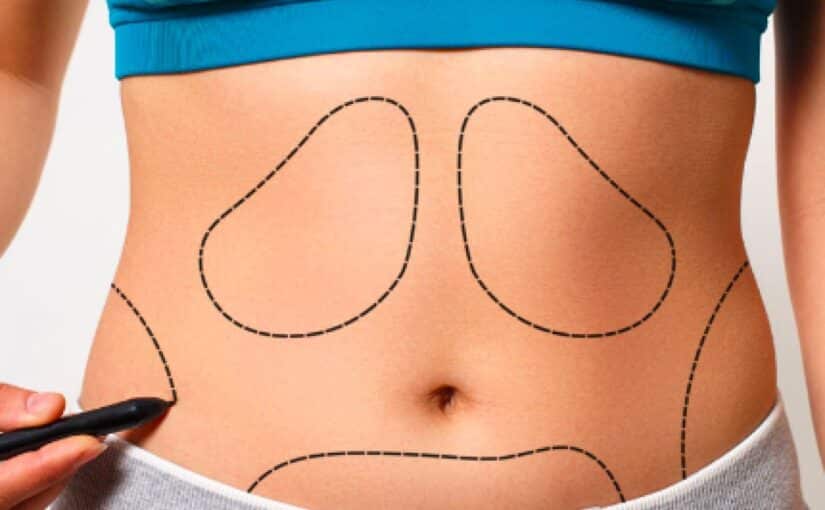 Liposuction Before and After Progress You Can Expect