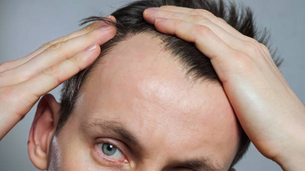 Stem Cell Hair Transplant: Minimizing Downtime After Therapy